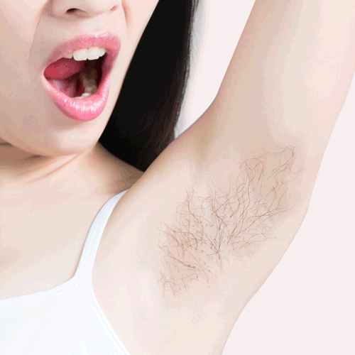 Sydonic hair Removal Treatment